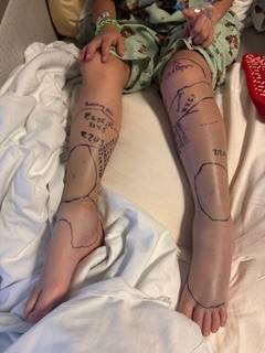 6 year old girl's swollen legs with snake bites