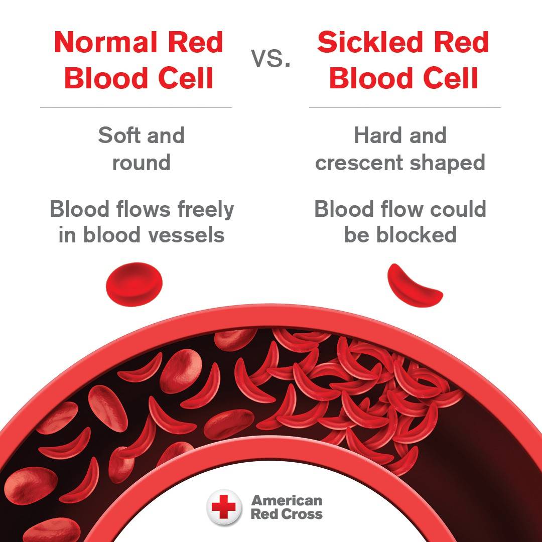Illustration of oblong and sickle shaped red blood cells with red words on a white background. Words read: Normal Red Blood Cell: Soft and round, Blood flows freely in blood vessels vs. Sickled Red Blood Cell: Hard and crescent shaped, Blood flow could be blocked.